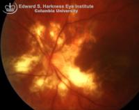 An active lesion with a relatively sharp border involving the macula of the left eye was noted. New lesions that are contiguous with the prior lesions are seen in the superotemporal region.